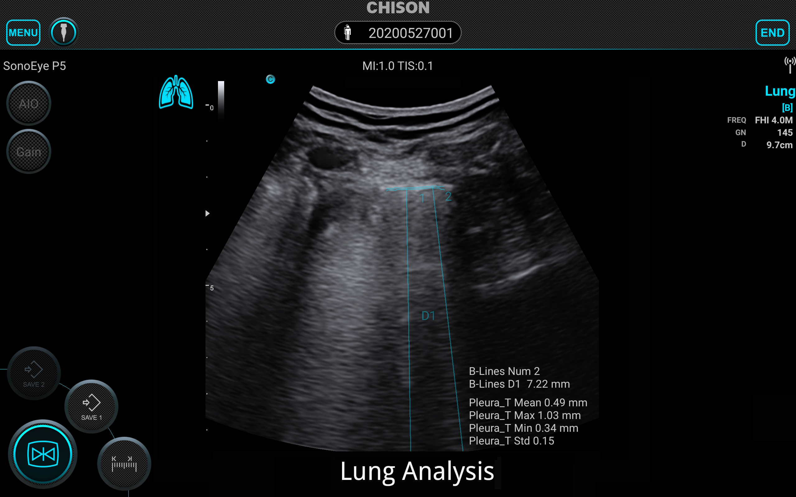SonoEye Lung Analysis